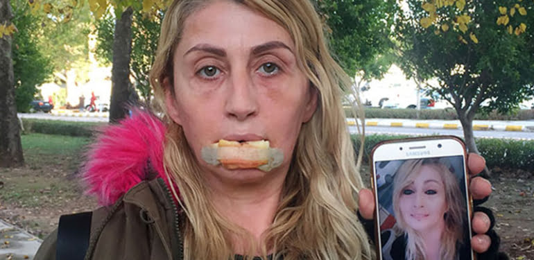 Güzellik uğruna kaybettiği alt dudağı eskisi gibi olmayacak