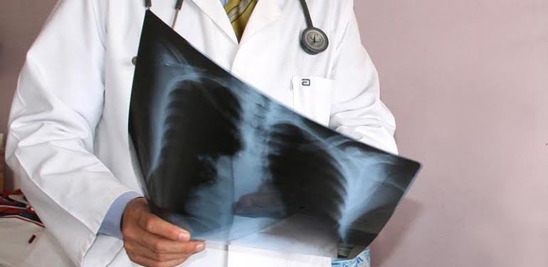 Maalesef gerçek: Akciğer kanserli sayısı artıyor!