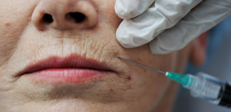 botox-kapak
