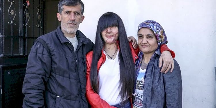 Yüzüne asit atan eski erkek arkadaşını affeden Berfin Özek: ‘Bunu nasıl yapabildim?’