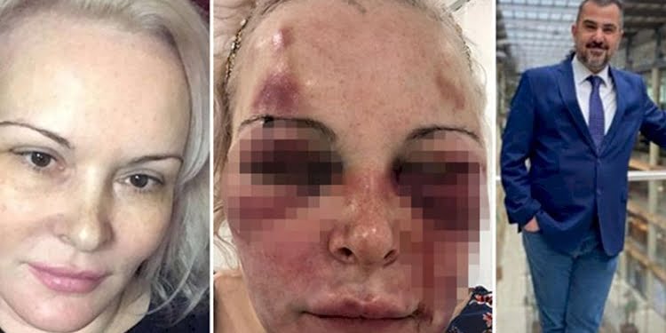 Şiddete uğrayan kadın: Yüzümden akan kanlar eline bulaşınca yalıyor, ‘Tadı ne güzel’ diyordu