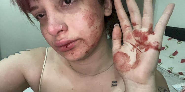 Sosyal medya ünlüsü genç kadın sevgilisinden dayak yedi