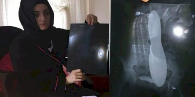 Ameliyatta karnında mala unutulan kadına ödenecek tazminat belli oldu