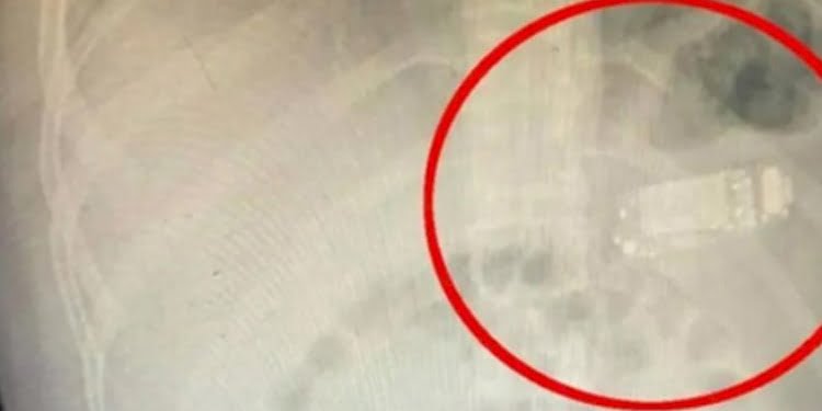 Priştine’de bir adamın midesinden Nokia 3310 çıkarıldı
