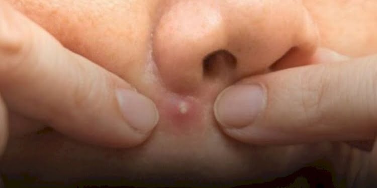 Yüzündeki sivilceyi sıktı: Beyni iltihapla doldu