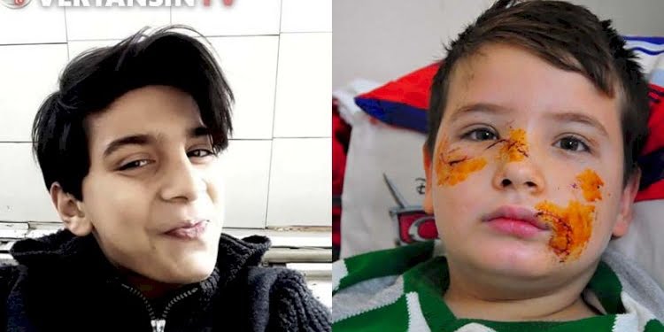 Enes’i köpek sürüsü parçaladı… Mert’in yüzüne 60 dikiş atıldı