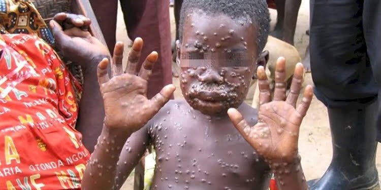 Kongo’da ‘maymun çiçeği’ salgını: 24 kişi öldü