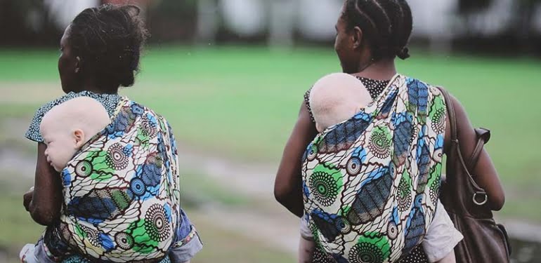 ‘Kara Kıtanın Beyaz Çocukları’: Afrikalı albinoların dramı sanatseverlerle buluştu