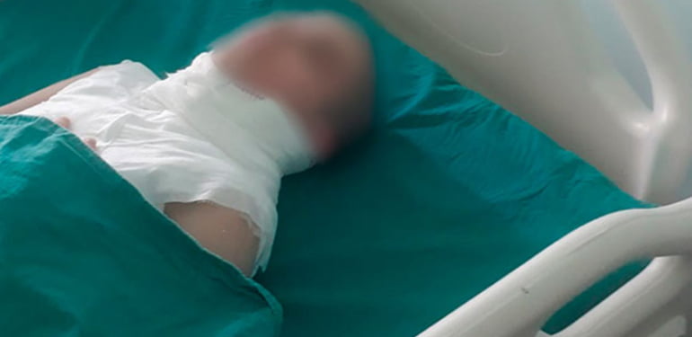 Üvey annesi tarafından yakıldığı öne sürülen kız 4. ameliyatını oldu