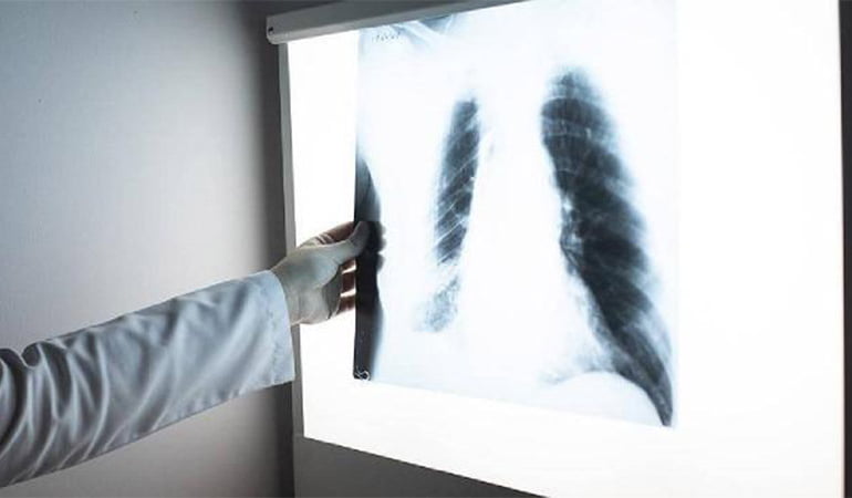 İnsan akciğerinde ilk kez mikroplastiğe rastlandı