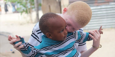albino