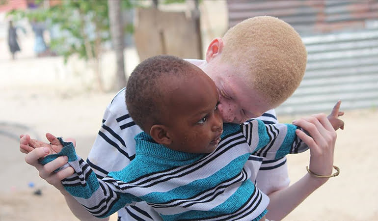 Kara kıtanın beyazları… Albino bireylere hayat daha zor