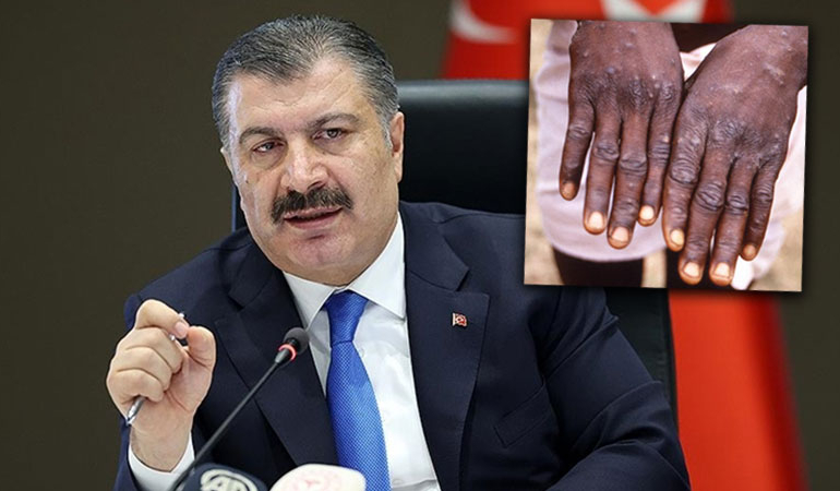 Maymun çiçeği Türkiye’de… Bakan Koca ilk vakayı duyurdu