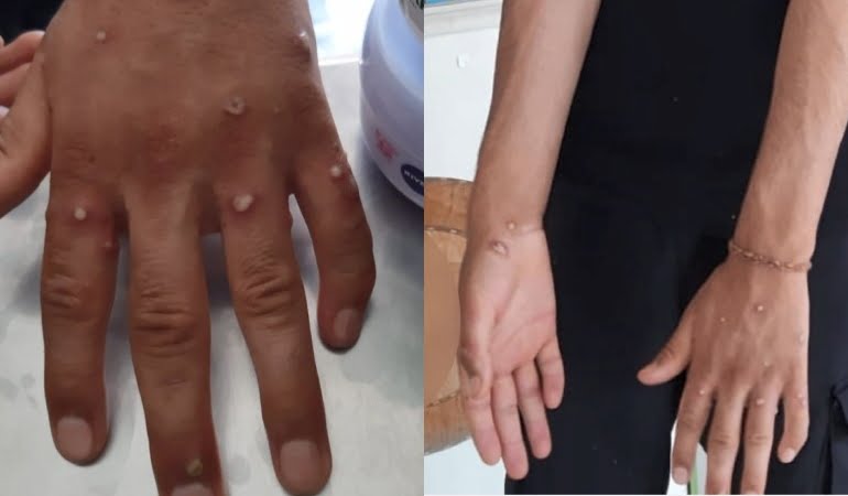 Sağlık Bakanı Koca’dan ‘maymun çiçeği’ açıklaması