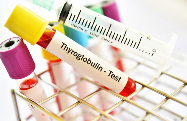 Tiroglobulin (TG) nedir? Tiroglobulin yüksekliği ne anlama gelir?