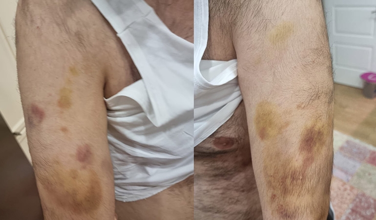 Otizmli öğrenciyi sopayla döven öğretmen tutuklandı