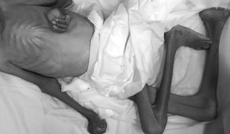 Sayıları her geçen gün artıyor: Gazze’de bir çocuk daha açlıktan öldü
